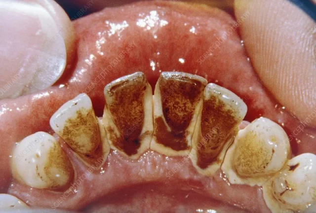 How To Remove Tartar From Teeth Without Dentist? Learn Some Natural Ways!