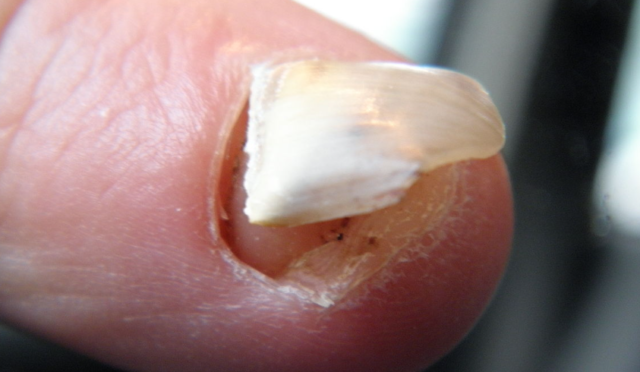 How To Get Nail To Reattach To Nail Bed? Tips To Deal With Your Painful Situation Here!