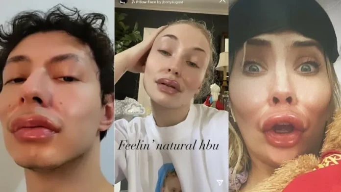 How To Get The Botox Filter On Instagram? 2 Quick Ways To Get A Pillow Face!